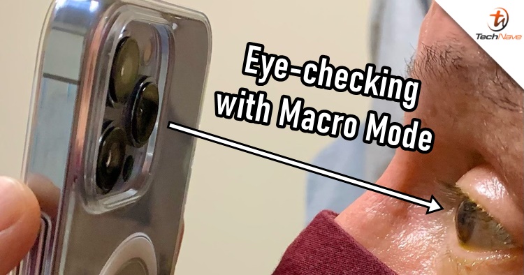 拚图两图）美医生称用iPhone 13 Pro微距拍摄病人眼睛 有助跟进术后康复