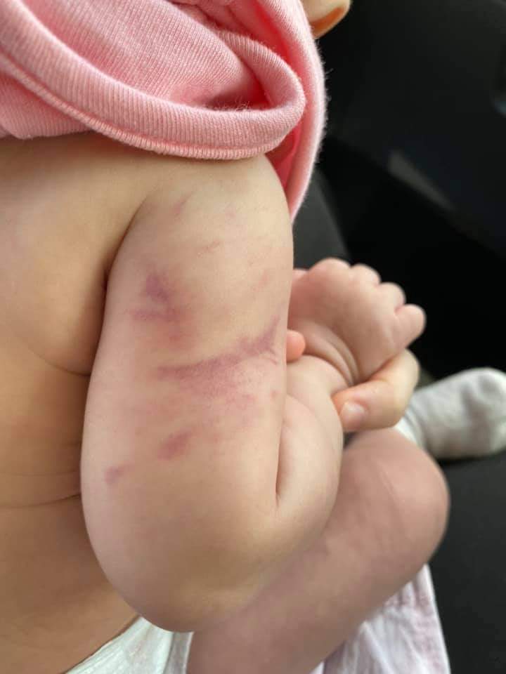 大都会//5个月大女婴手臂有红色瘀痕·父亲疑女儿遭保姆虐待报警