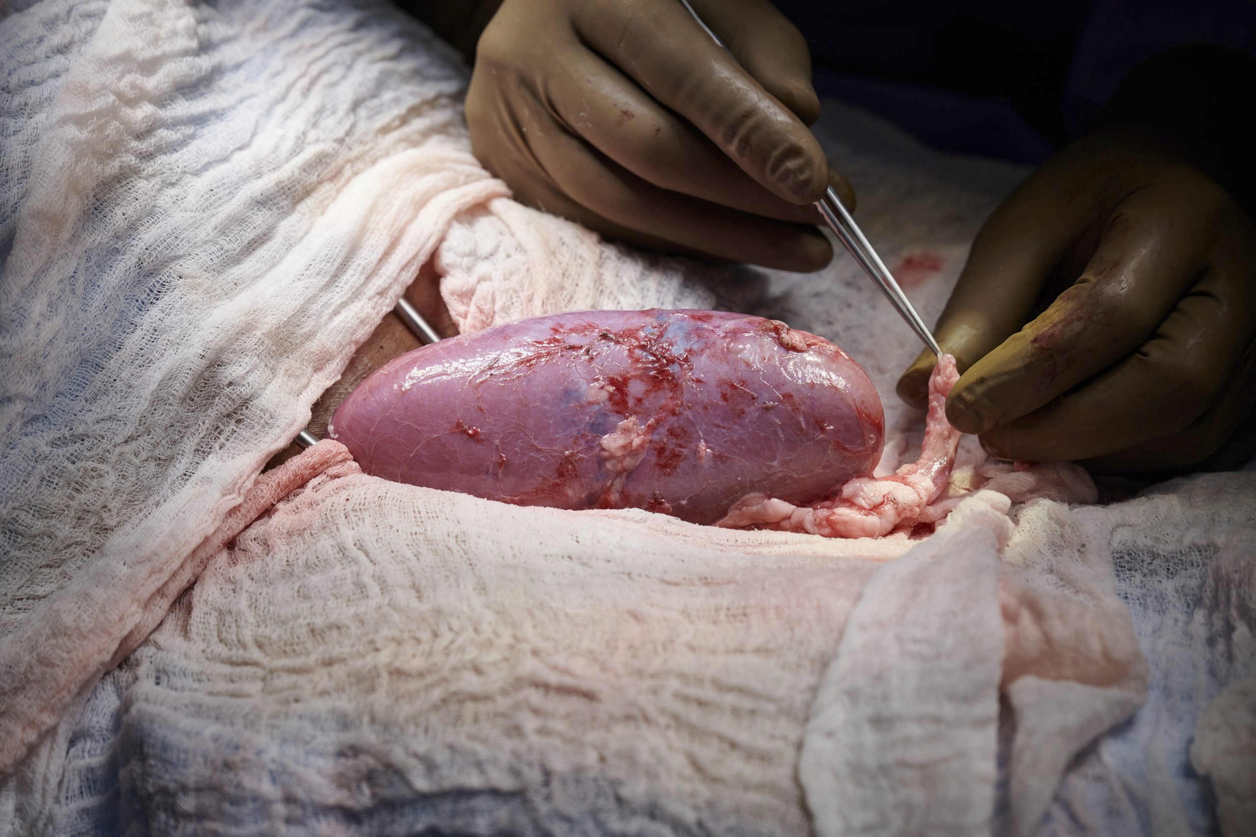 拼盘  美国肾脏移植实验大进展　基因改造猪肾植入人体未引起排斥
