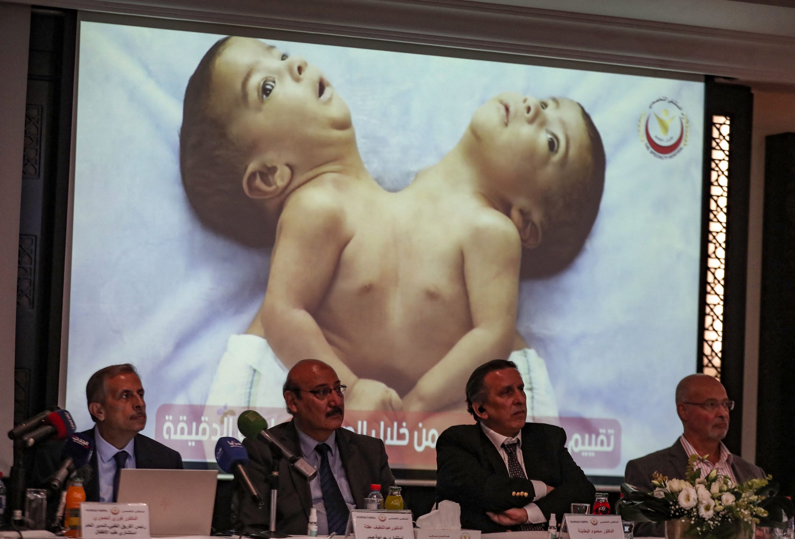 拼盘2图   也门连体婴赴约旦做手术 成功分离“可像一般儿童生活”