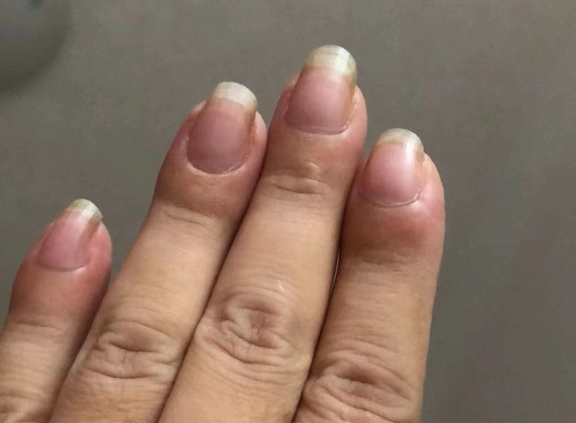 拼盘／中国女子10根手指肿成“萝卜” 一检查竟是肺癌