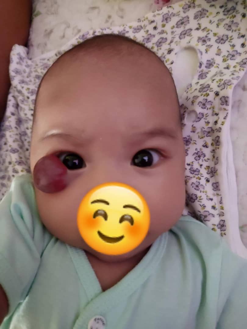 视频 | 可怜宝宝眼角小斑点竟是血管瘤·一摸就流血
