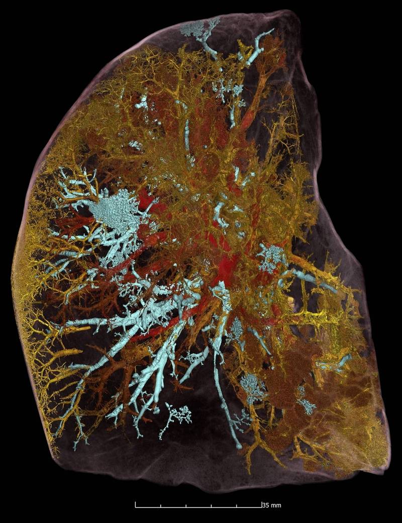 看世界 //史上最强X光 首揭冠病死者肺部损伤细节