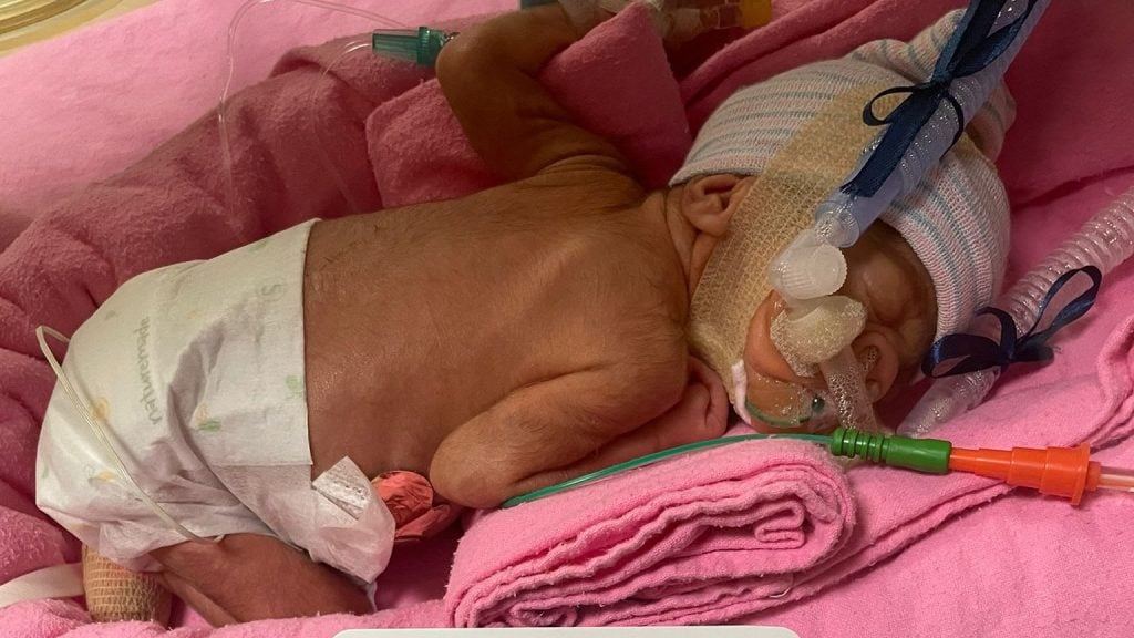 宝宝仅一公斤皮肤几乎透明 外籍孕妇狮城早产网上求助