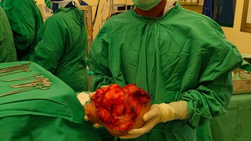 病患颈部肿瘤重3公斤  医生：“从医11年第一次见”
