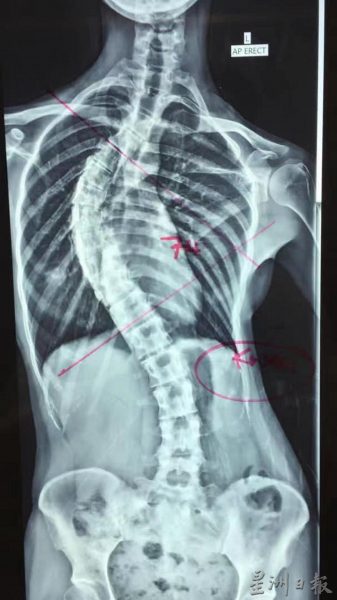 供FB／孔玮婷脊椎骨弯曲 需做矫正手术，国会议员拨款手术费