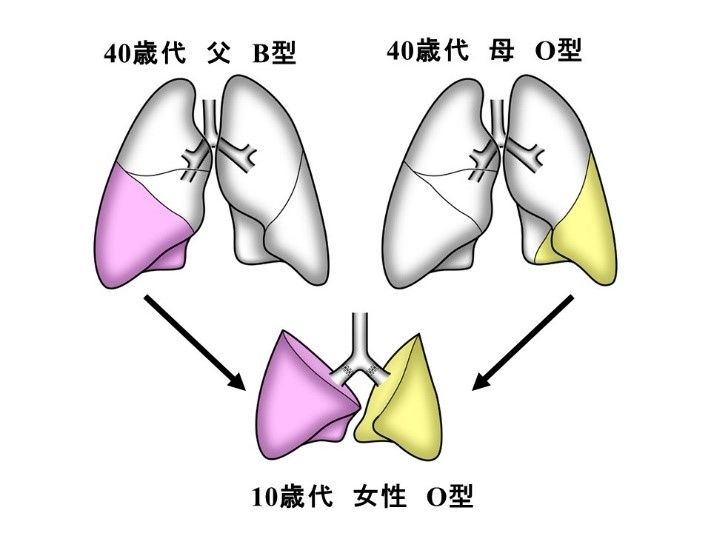 全球首例！不同血型肺部移植成功 日本B型爸捐肺给O型女儿 