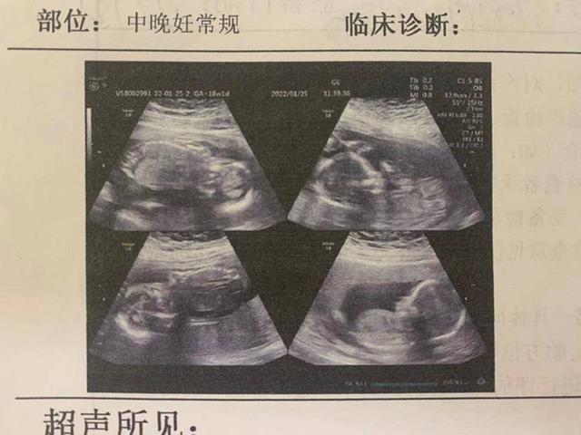 拚图两图）山东四胎孕妇罕见多次分娩 头2婴隔4天出世2个仍留腹中