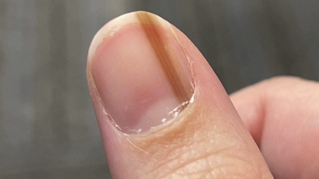 指甲长诡异褐线10年 检查才知是罕见皮肤癌