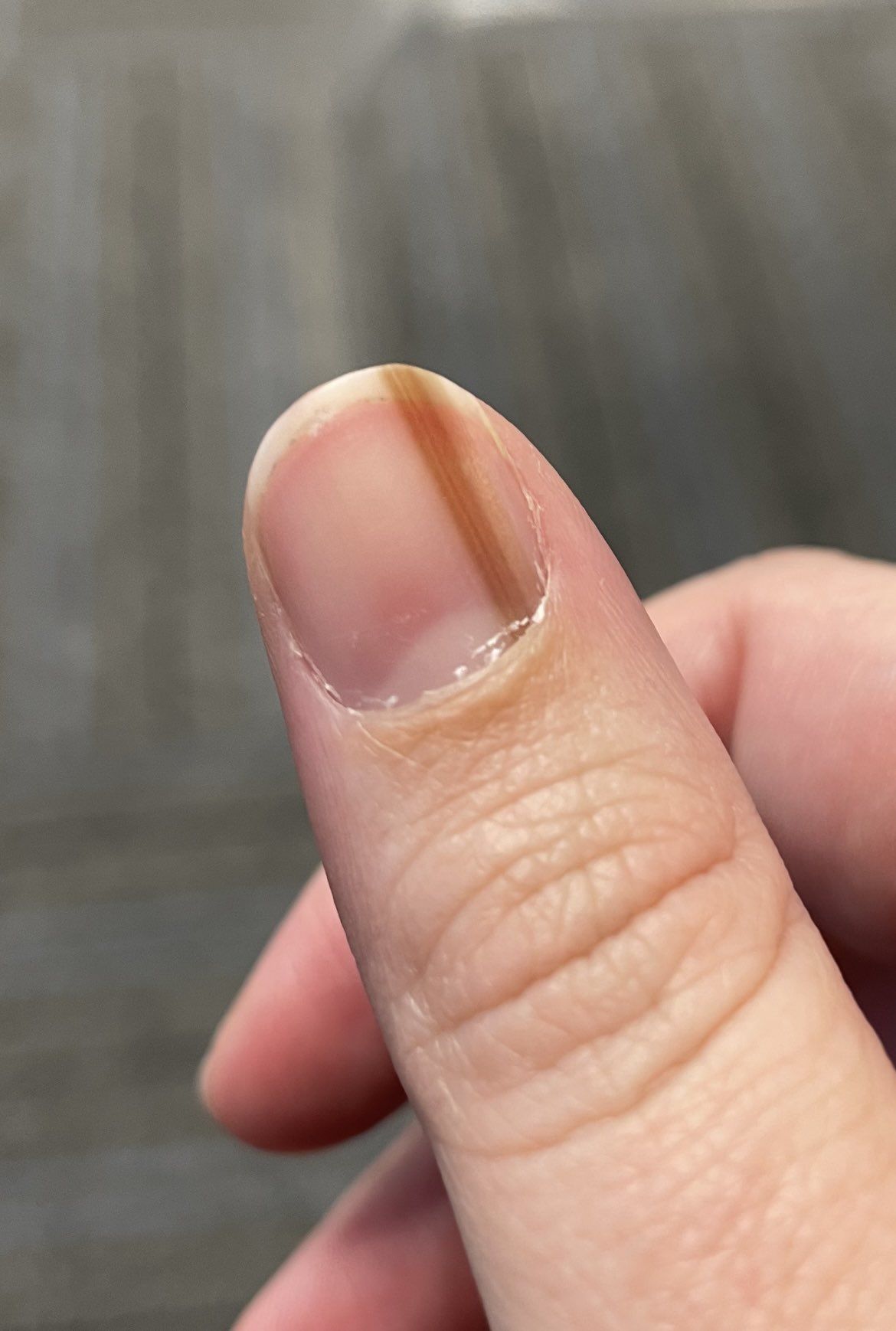 指甲长诡异褐线10年 检查才知是罕见皮肤癌
