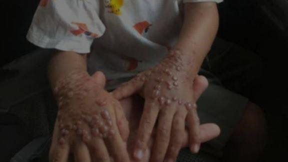 我国3岁童发烧皮肤水泡 诺希山：检验证实非猴痘
