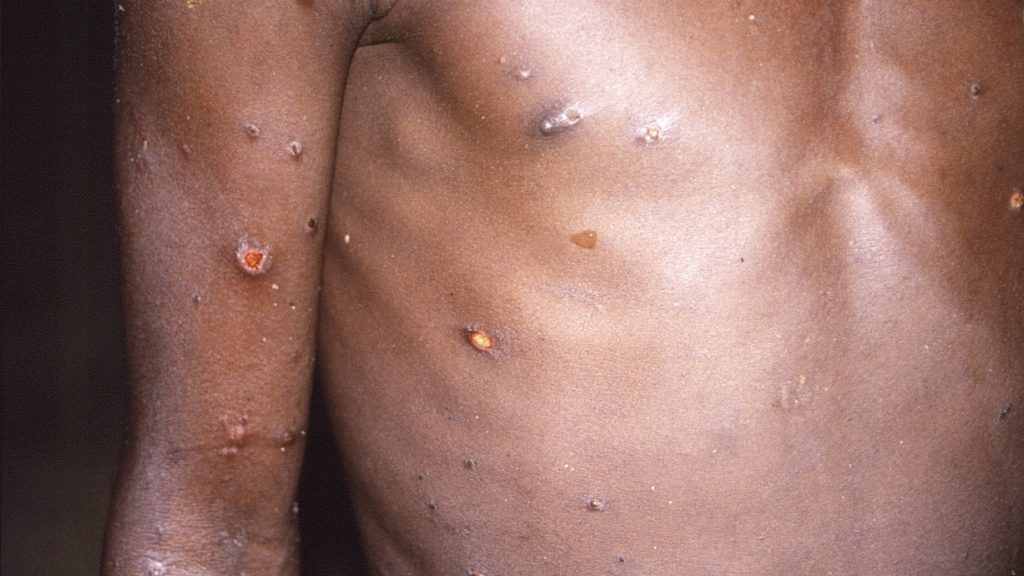 欧美病例频传     猴痘是什么？有多严重？