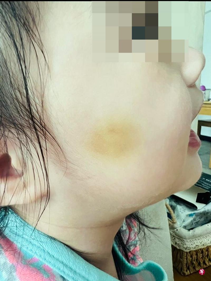 （已签发）狮城二三事：2岁女童带伤回家 家长报警控诉幼儿园 