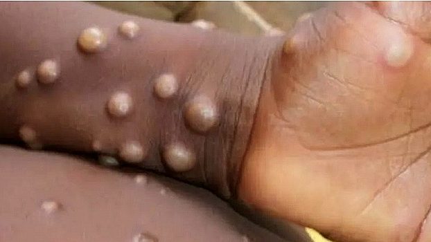 Monkeypox: ‘too early to call it an epidemic’