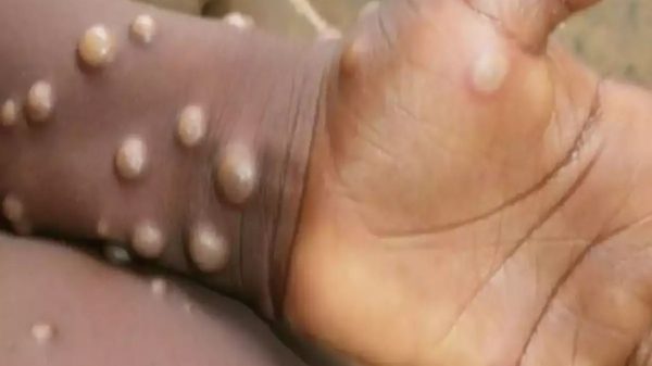 猴痘疫情蔓延全球20国 瑞士药厂已研发出快筛试剂
