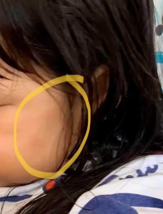 2岁女童遭幼教捏脸瘀青 母：“该这样被对待的吗？”