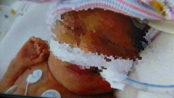 早产婴出世12天夭折 遗体竟被当脏布丢弃