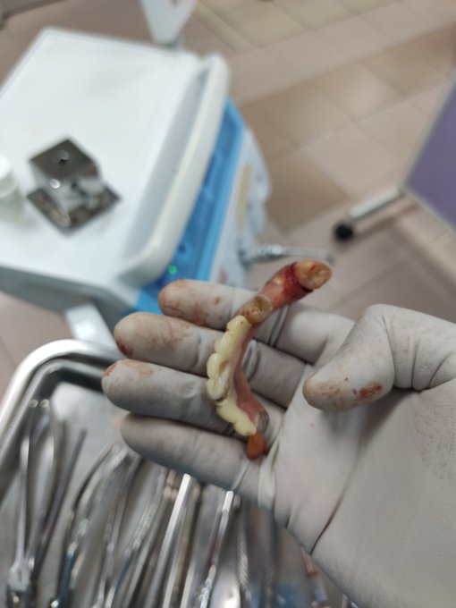 男子以贵5倍价装到假的假牙  牙医：政府诊所整排假牙才RM100