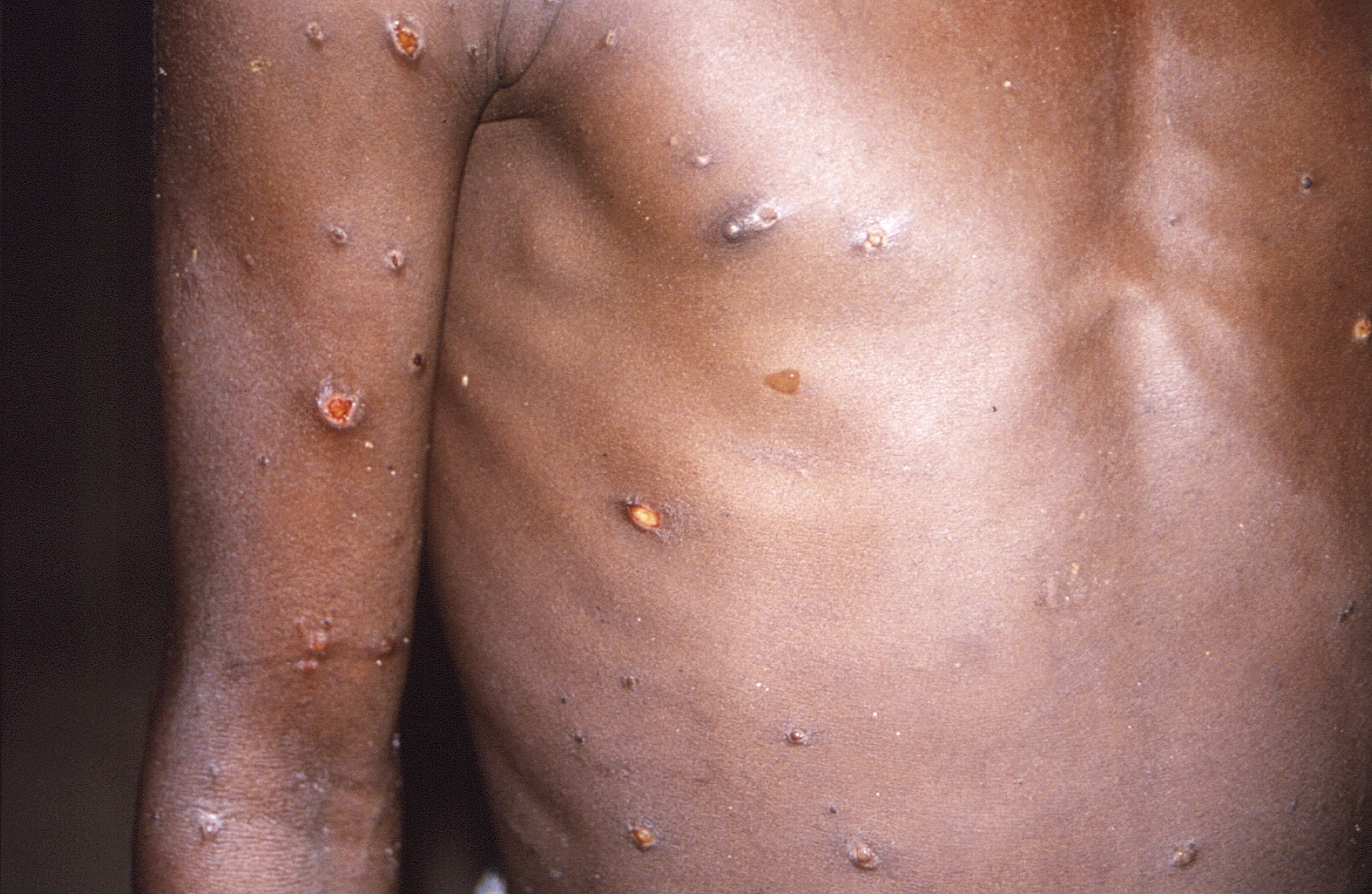 避免猴痘蔓延更多国家 世卫：非洲须一同对抗