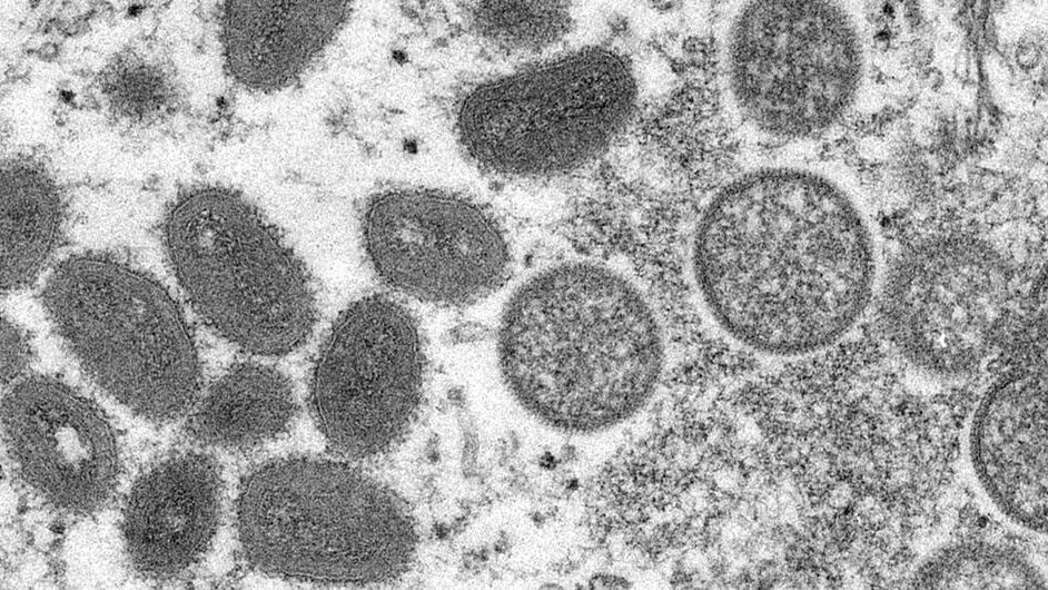猴痘疫情爆发不寻常    世卫:39国报告逾1600例