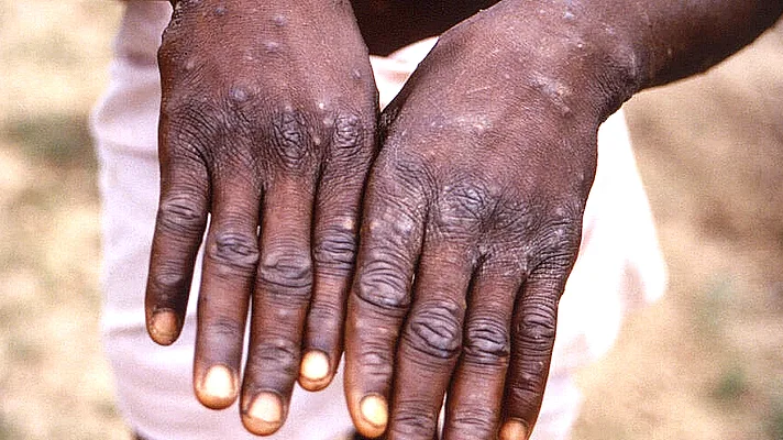 Monkeypox outbreak tops 1,000 cases, WHO warns of real risk
