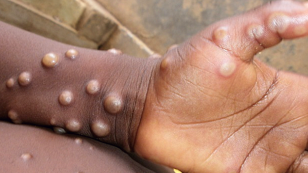 South Korea reports first imported case of monkeypox
