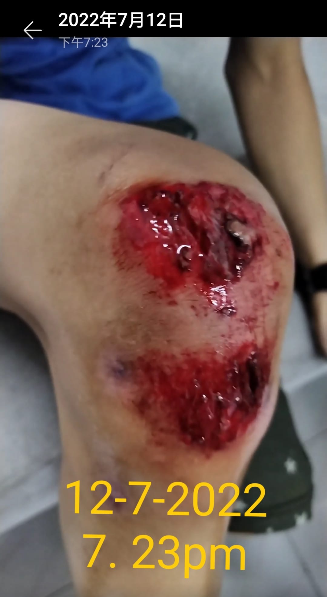 东：男童骑脚车撞及路边坑洞膝盖皮开肉绽