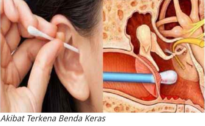 耳垢有5大功能无需挖掉 耳鼻喉专科：小心挖破耳膜