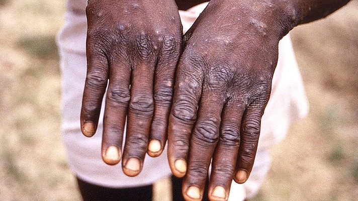 Monkeypox: From beginnings in Africa to global spread
