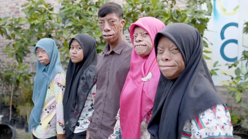 印尼四兄妹罹患怪病长相如河马 受尽歧视仍乐观面对