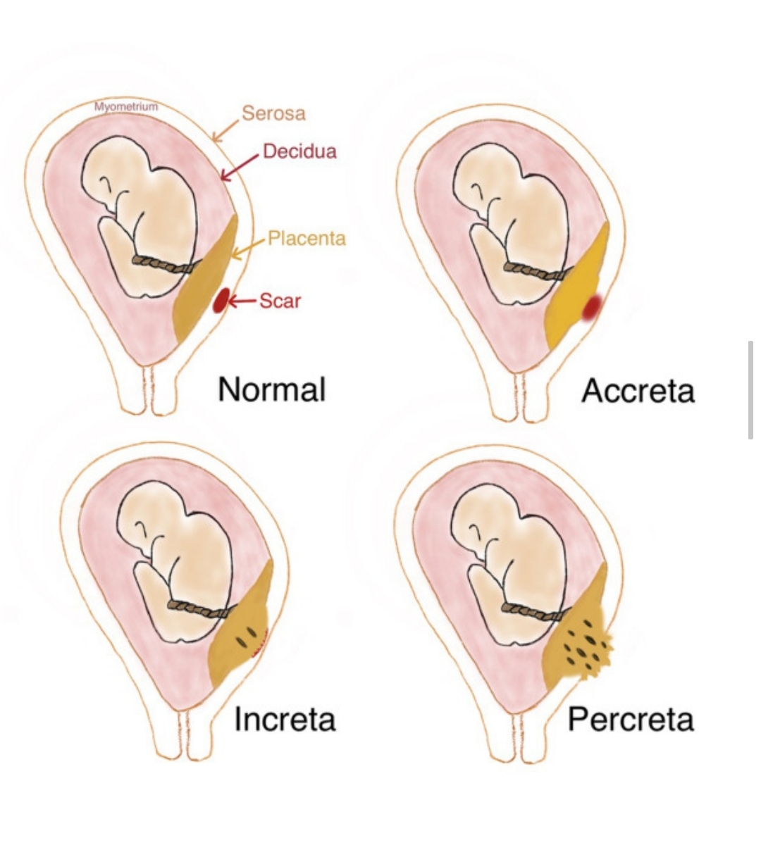 （大北马）孕期岀血的病因: 前置胎盘、植入性胎盘和前置血管
