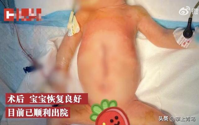  深圳一男婴出生拥4手4脚 医生指概率是50万分之一