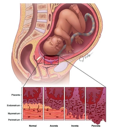 孕妇生产后全身紫红瘀青 医生：胎盘黏子宫壁造成！