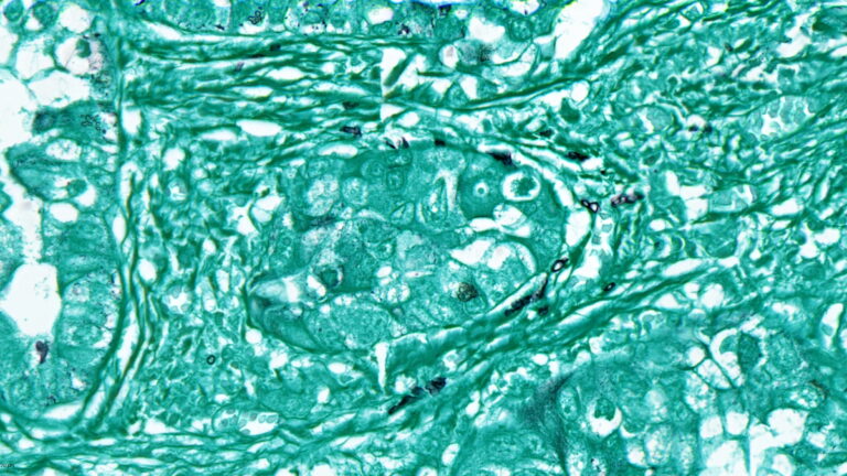 拼盘／新研究：肿瘤中真菌可能有助癌症诊疗