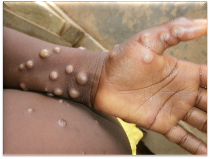 非洲猴痘爆发无疫苗与药物 病患只能“等待”