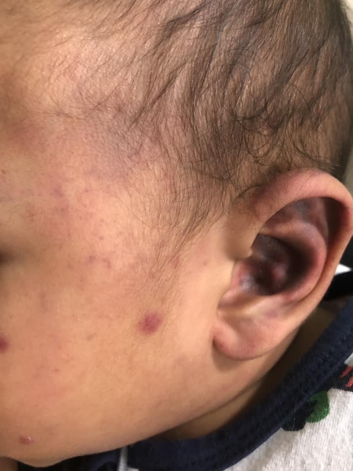 1岁儿送保姆家3天耳朵脸颊瘀青 母控诉“她说来月事不小心捏伤”