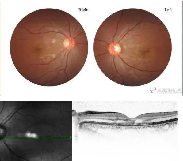 中20岁女染疫发烧3天后近乎失明　确诊为冠病引致视网膜病变