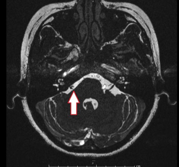 正常情况下右边颜面神经线的出口处（红箭头处）。