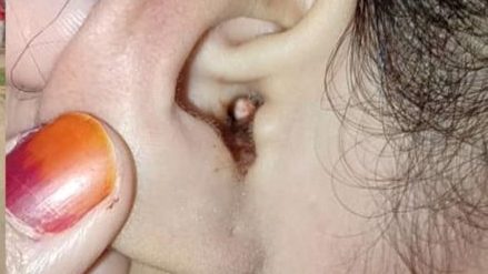 女童将橡皮檫塞进耳洞！耳壁出血 诊所医生试了2次都取不出