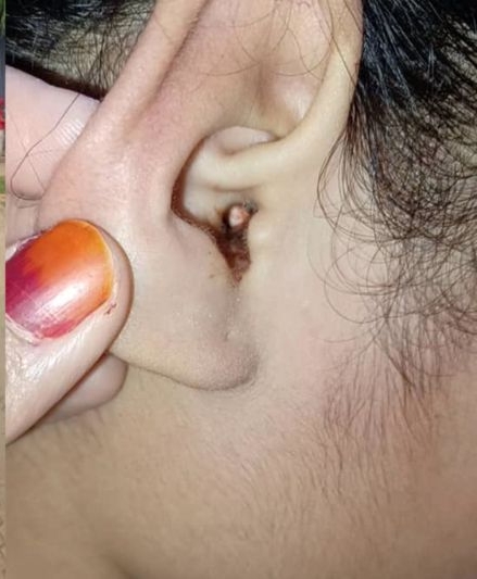 女童将橡皮檫塞进耳洞！耳壁出血 诊所医生试了2次都取不出