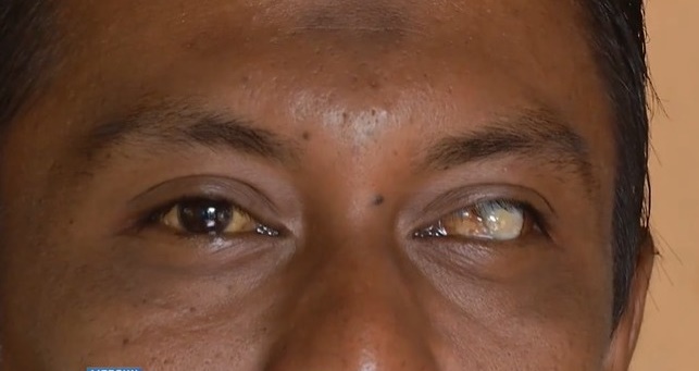 （全国版）19年前被球炮（Mercun Bola）碎片刺盲左眼的莫哈末阿都阿敏（29岁）并不赞同政府合法化爆竹烟花。