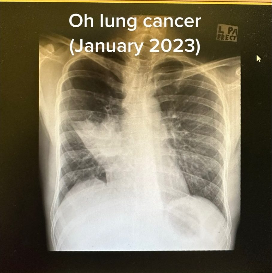 视频 | 22岁医学生发烧胸口痛·没抽烟竟患第三期肺癌