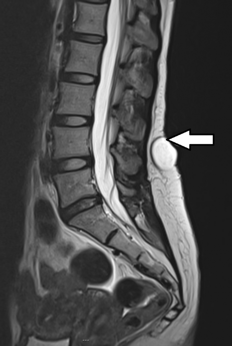 盛晓峰／背部脊椎上小肿瘤  要先排除脊柱发育不全