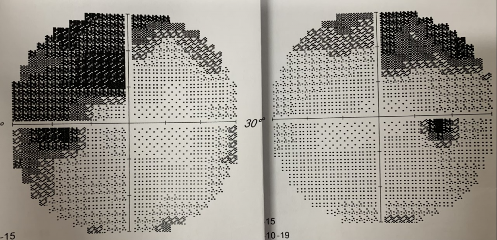 盛晓峰／月事失调 视力缺损 常昏厥  原来垂体大腺瘤作怪