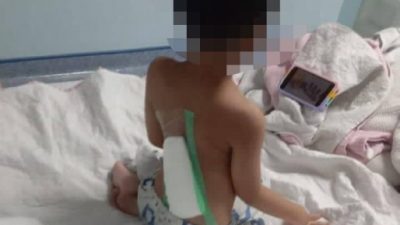 遭不明腐蚀性液体泼背  6岁男童遭烧伤入院