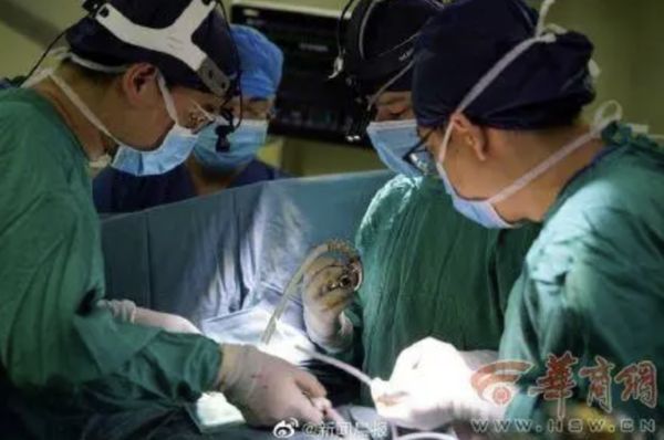 中国首例“心脏不停跳”人工心脏植入手术　心衰患者术后可爬山