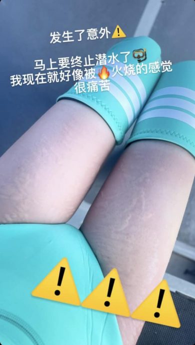 为美没穿全身潜水衣被海葵蛰伤·女子：好像被火烧 很痛苦！