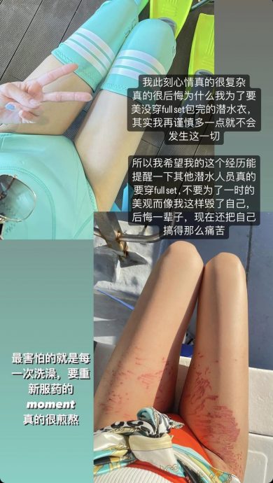 为美没穿全身潜水衣被海葵蛰伤·女子：好像被火烧 很痛苦！