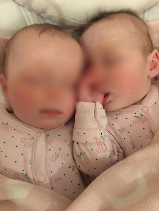 拼盘／双胞姐妹出世体型差异大　意外揭母相隔28天受孕