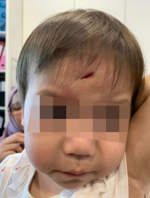 （已签发）柔：狮城二三事：女童幼儿园撞伤额头  花1.3万新元动手术